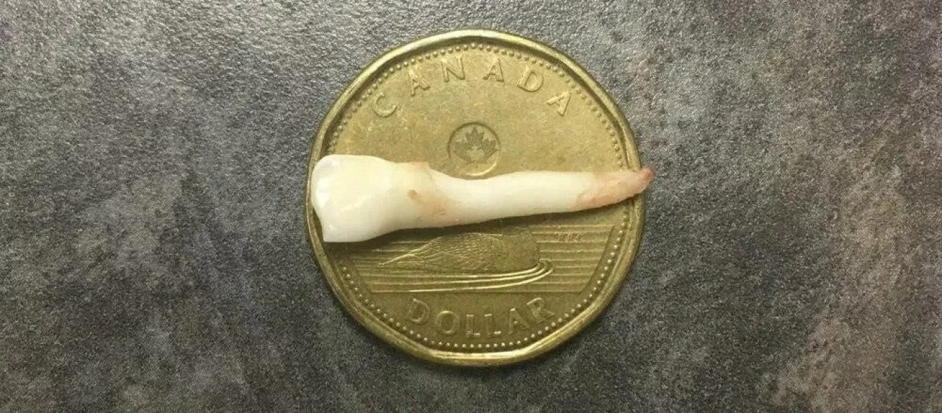 Καναδάς: 9χρονος έχει το μεγαλύτερο παιδικό δόντι - Είναι 2,6 εκατοστά (φώτο)